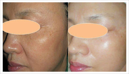 tightening tripollar treatments tripolar radiofrequency fractional